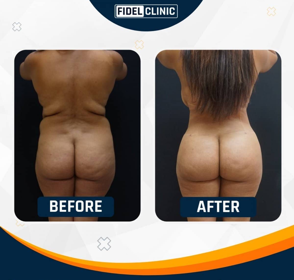 Case 19098 - liposuction