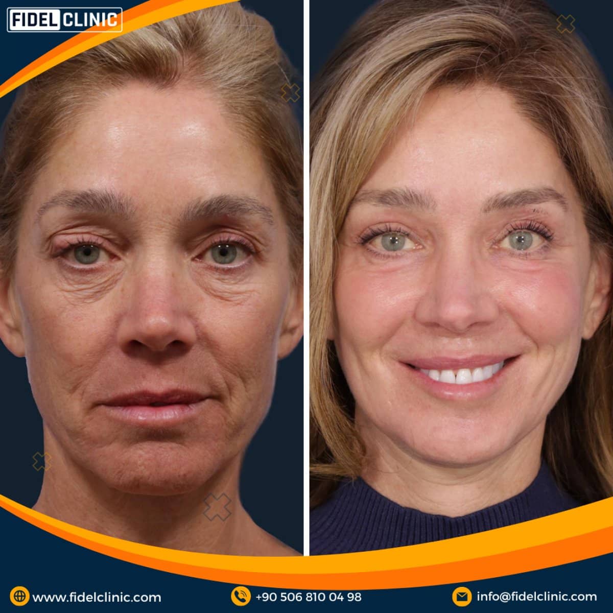 Case 19099 - blepharoplasty