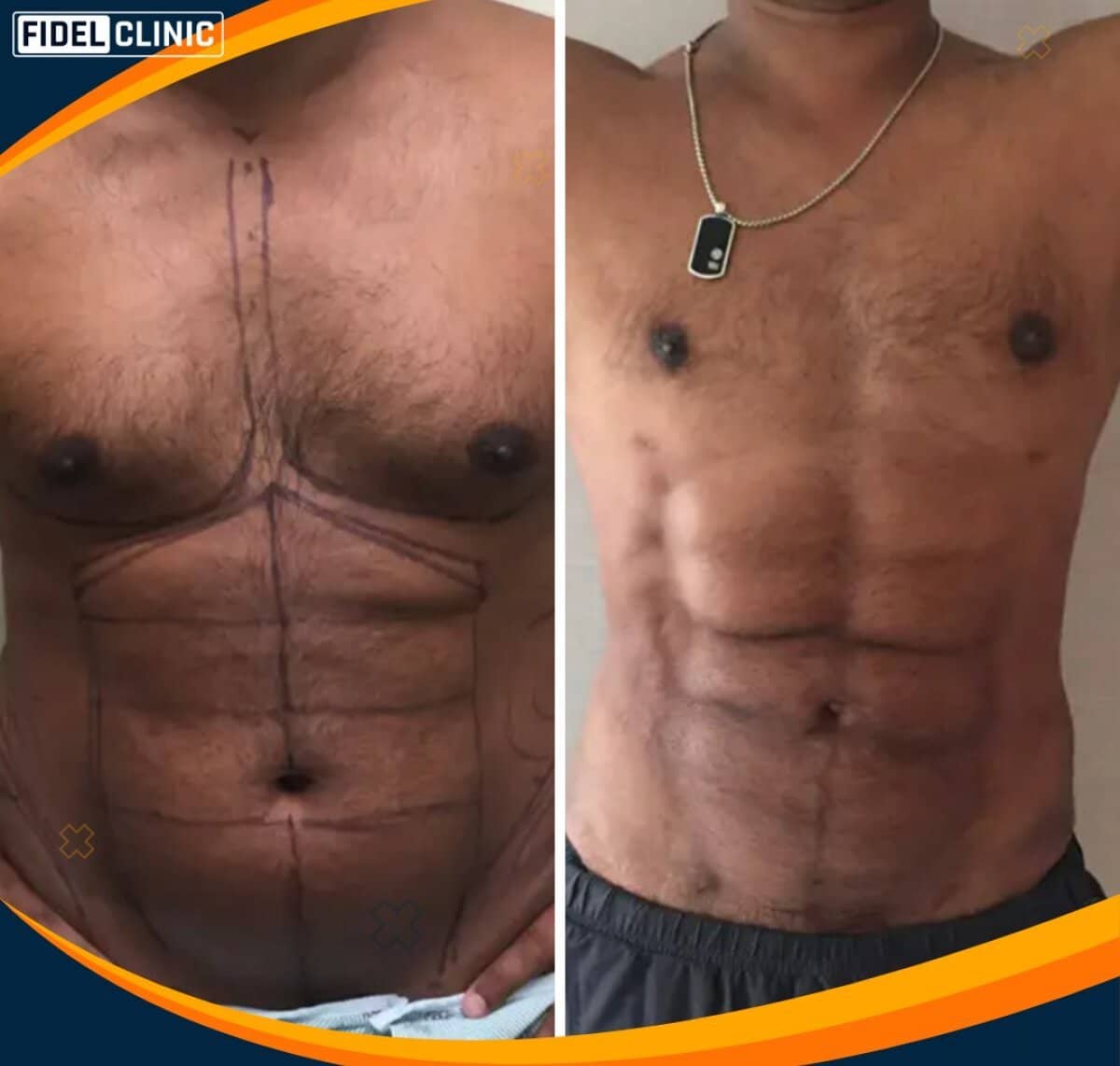Case 19100 - abdominal etching