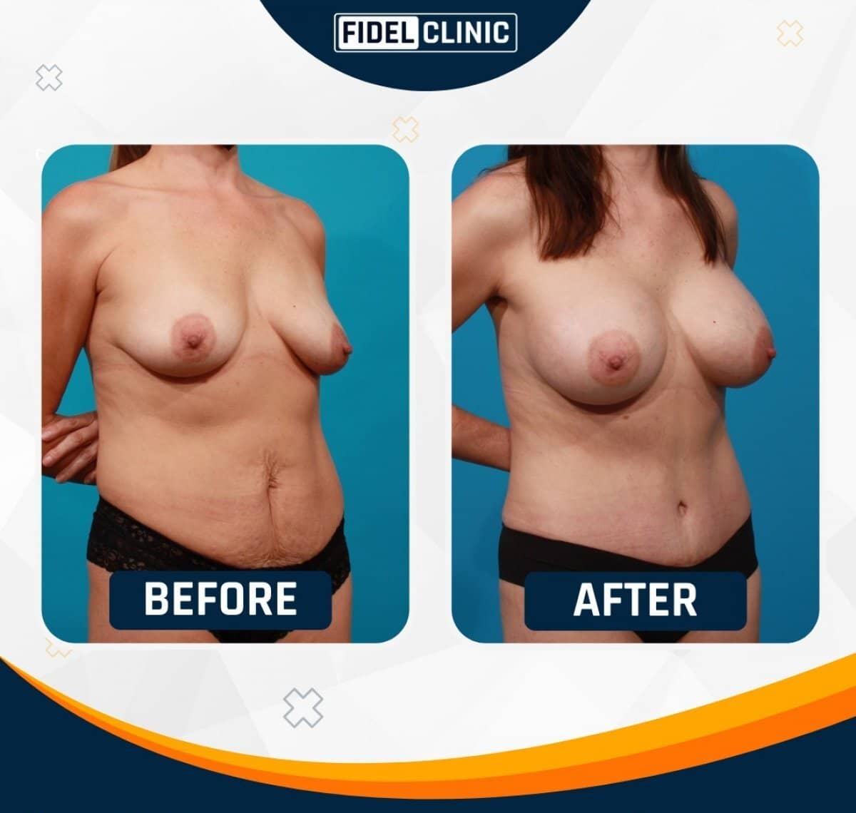 Case 19101 - breast lift