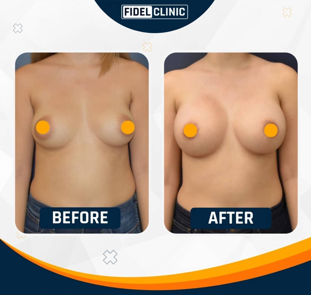 Case 19102 - breast augmentation