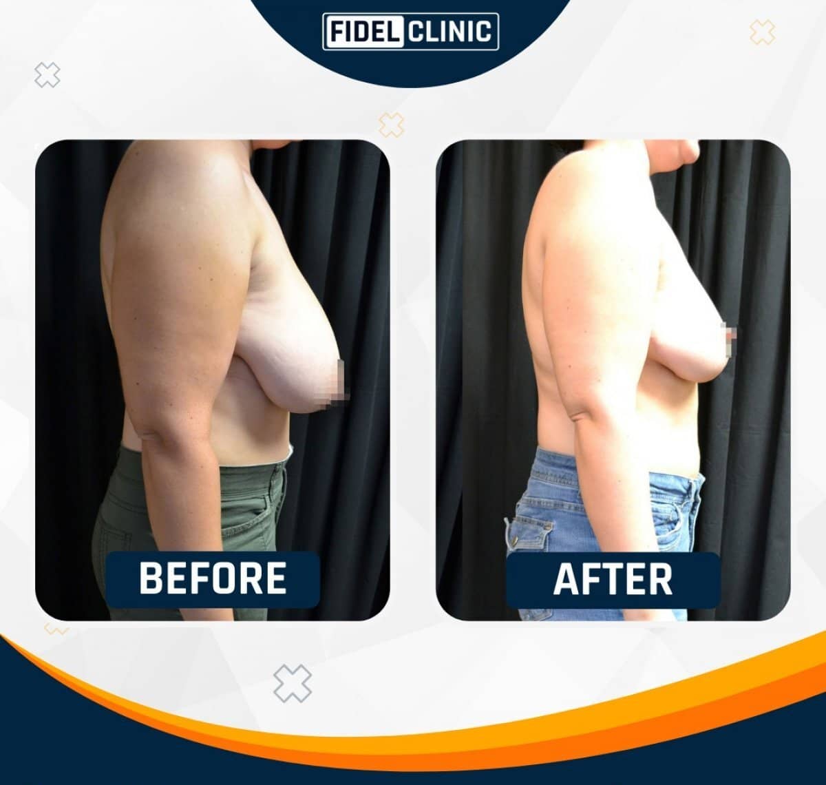 Case 19103 - breast reduction