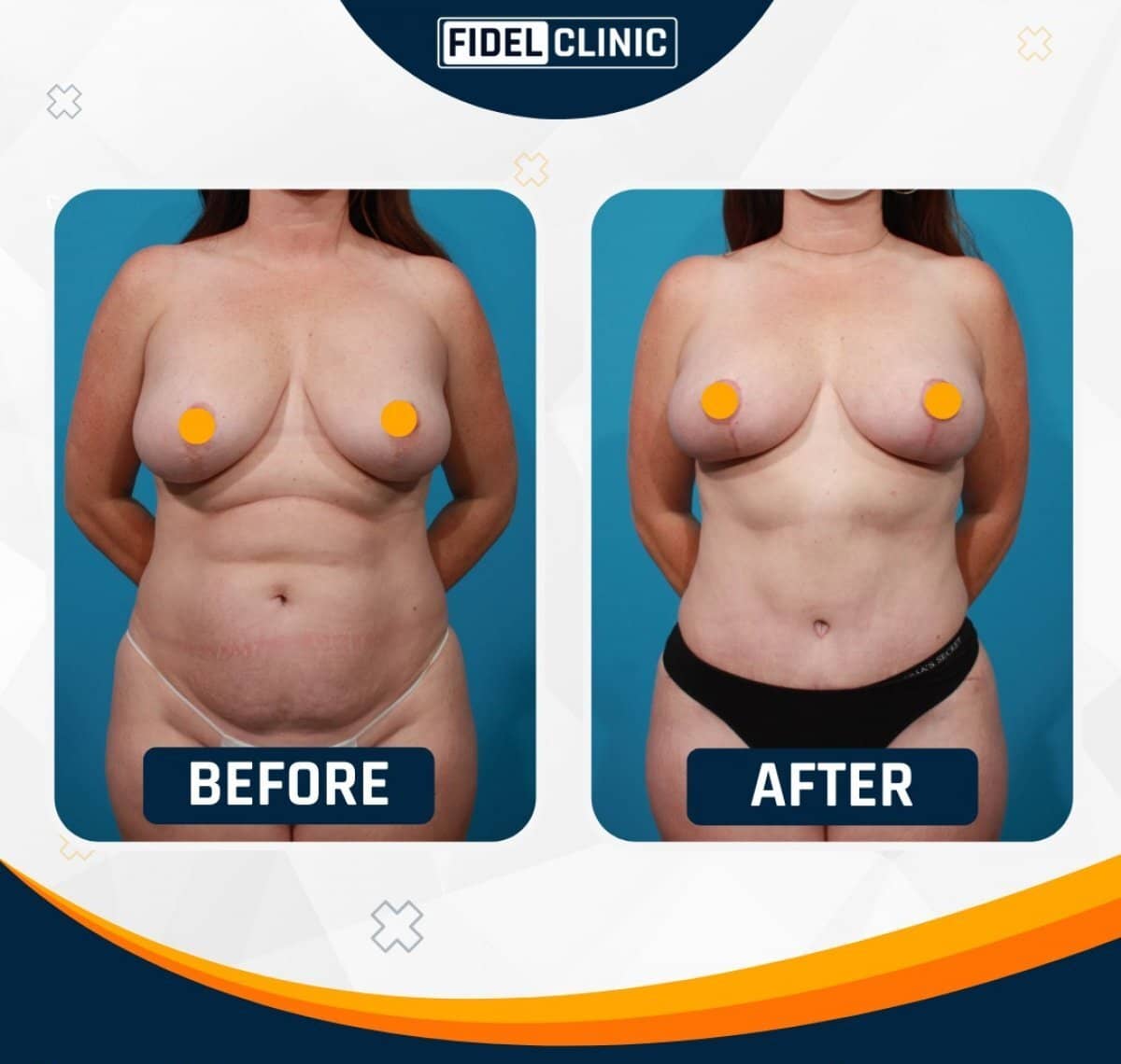 Case 19104 - tummy tuck