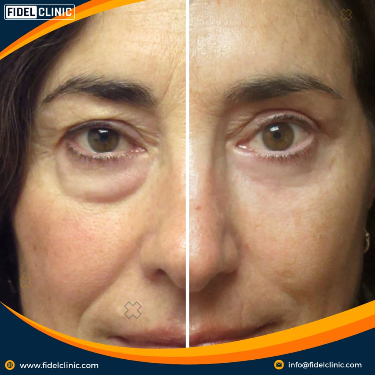 Case 19105 - blepharoplasty