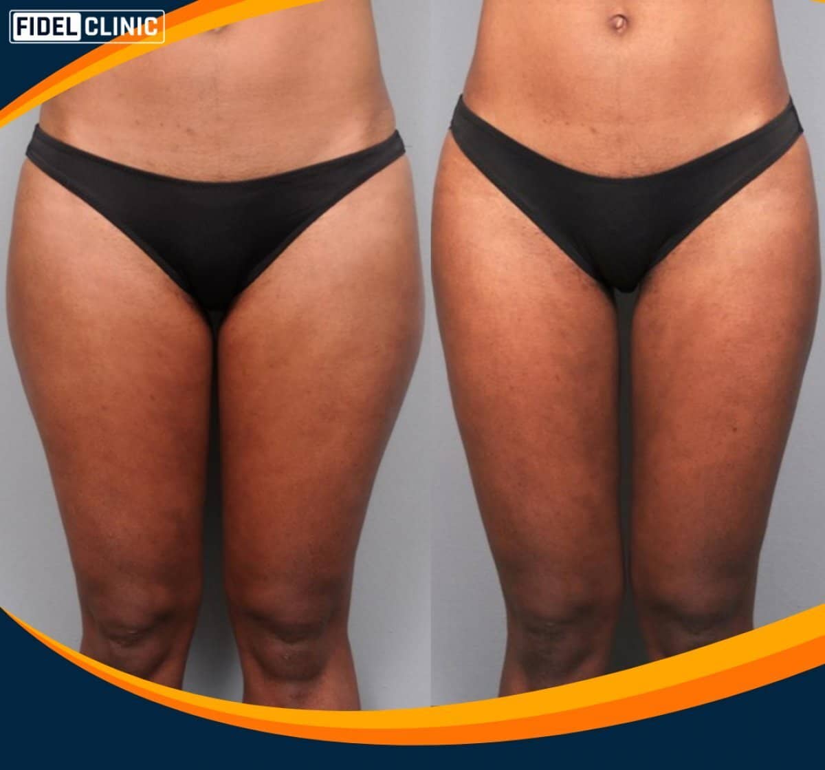 Case 19106 - Vaser liposuction