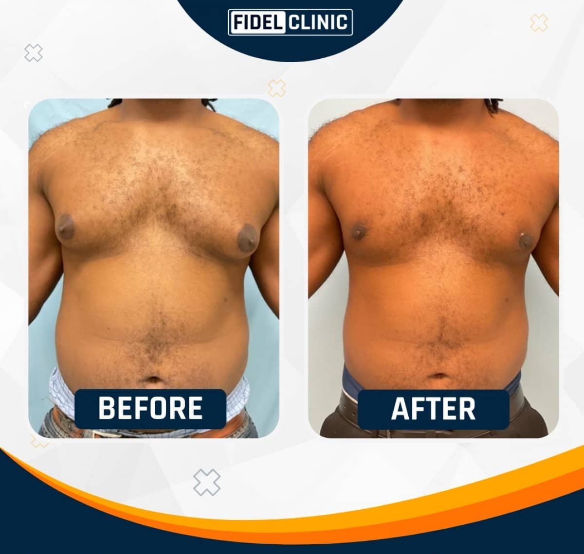 Case 19108 - gynecomastia surgery