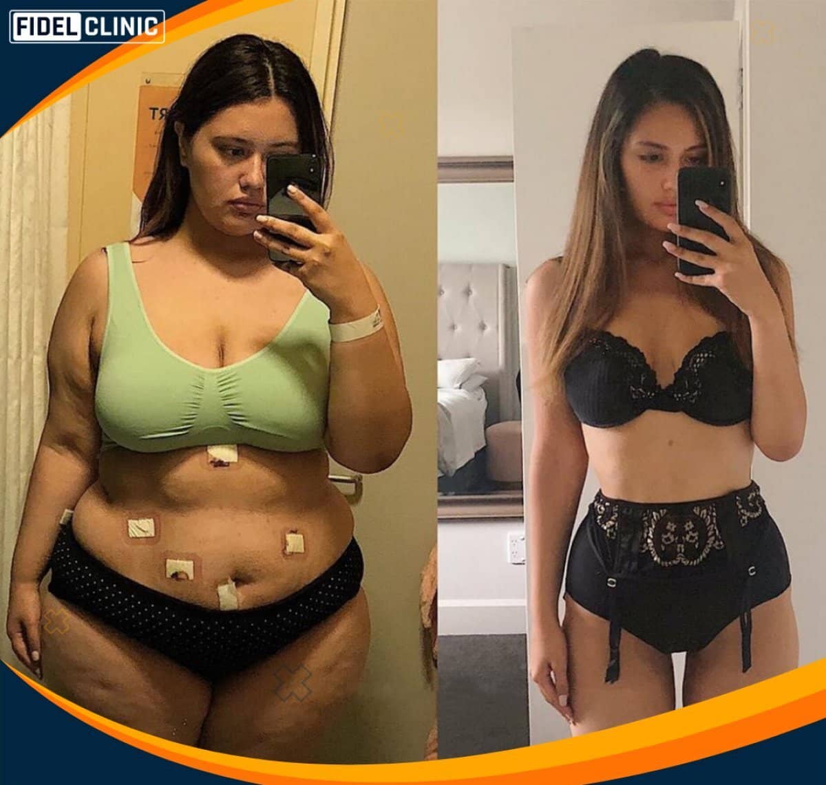 Case 19109 - gastric sleeve surgery