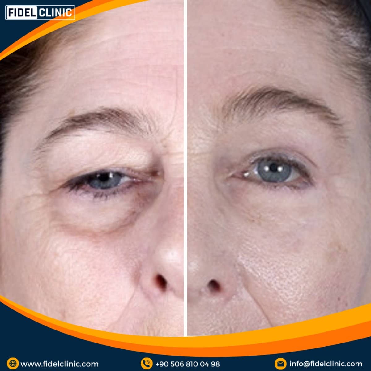 Case 19110 - blepharoplasty