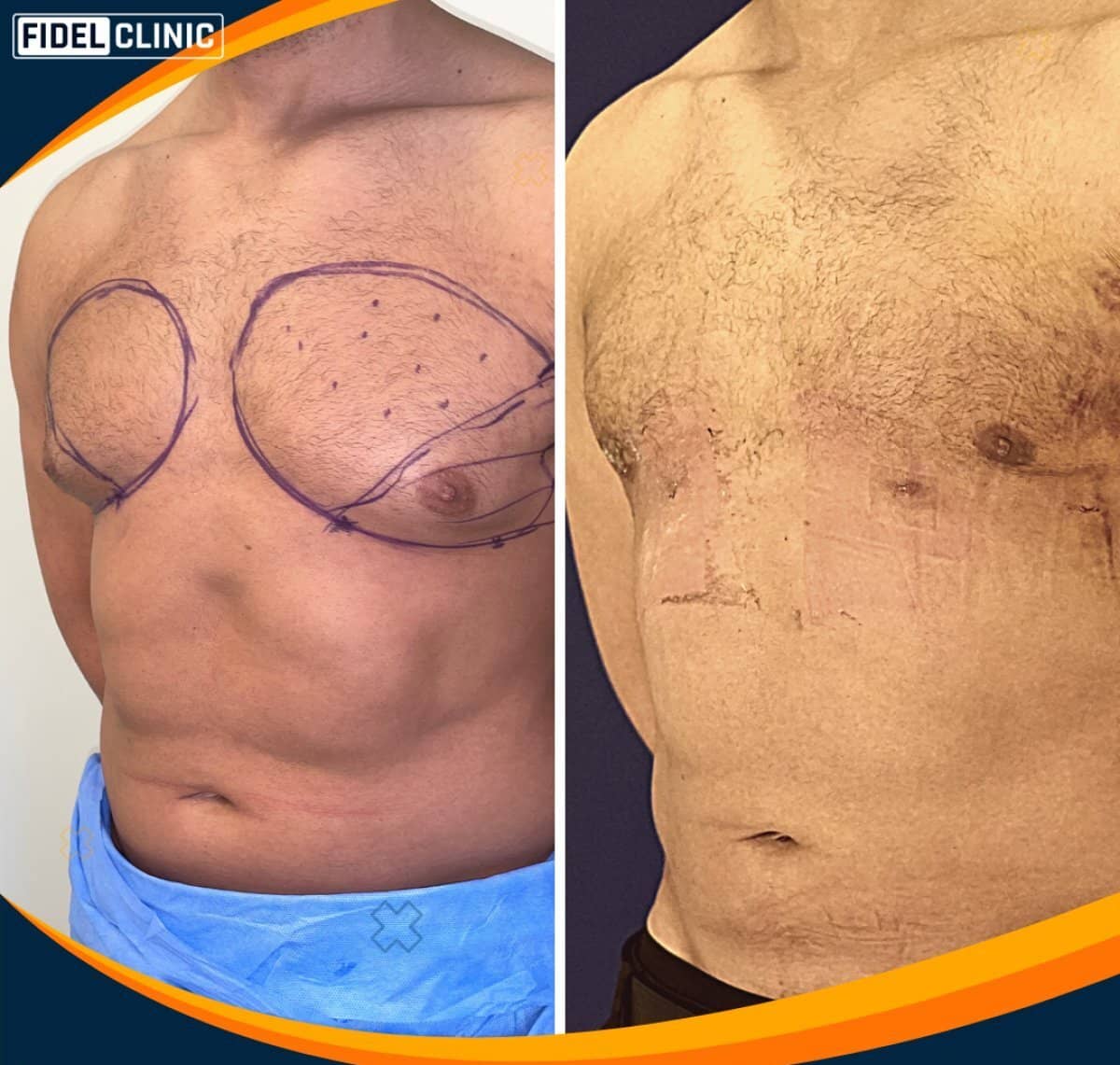 Case 19115 - gynecomastia surgery
