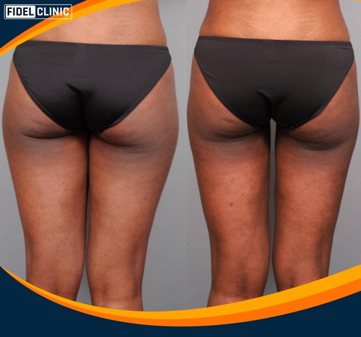 Case 19116 - Vaser liposuction