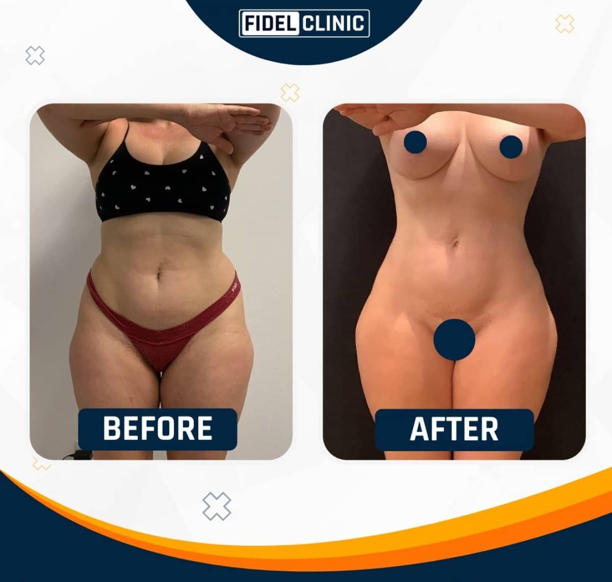 Case 19117 - liposuction