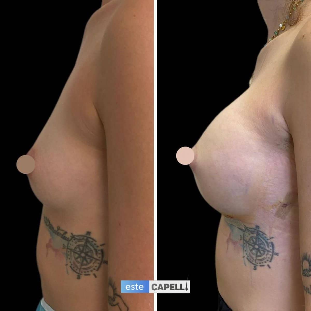 Case 19132 - breast augmentation