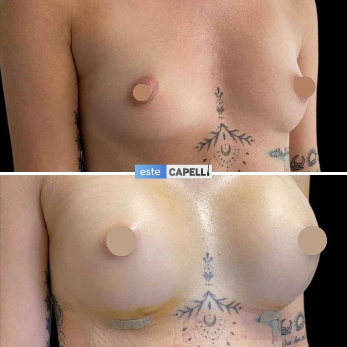 Case 19133 - breast augmentation