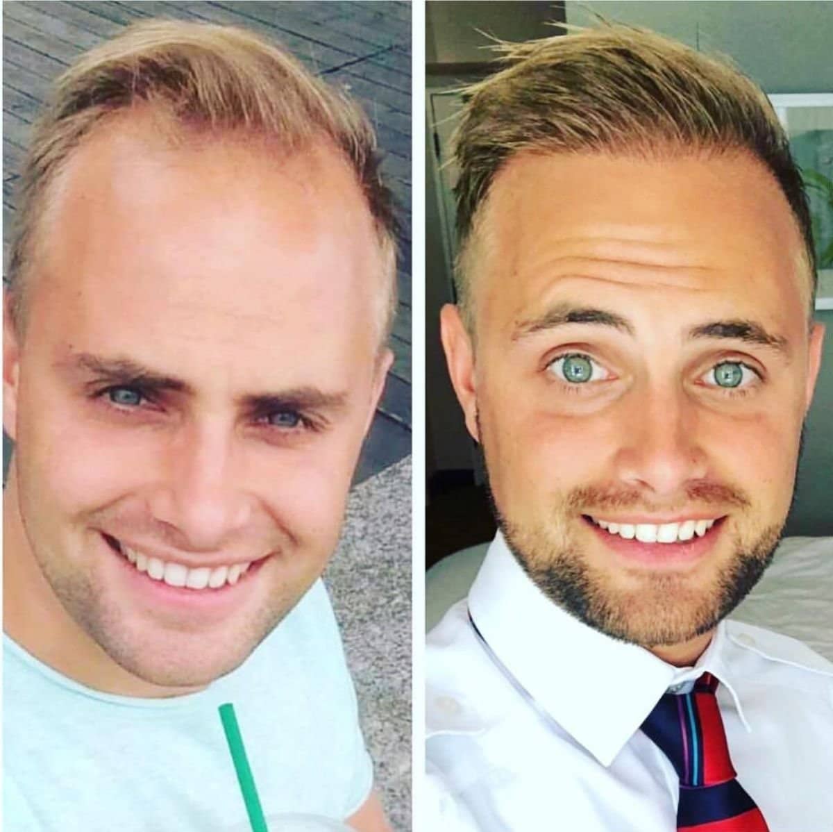 Case 19177 - hair transplant