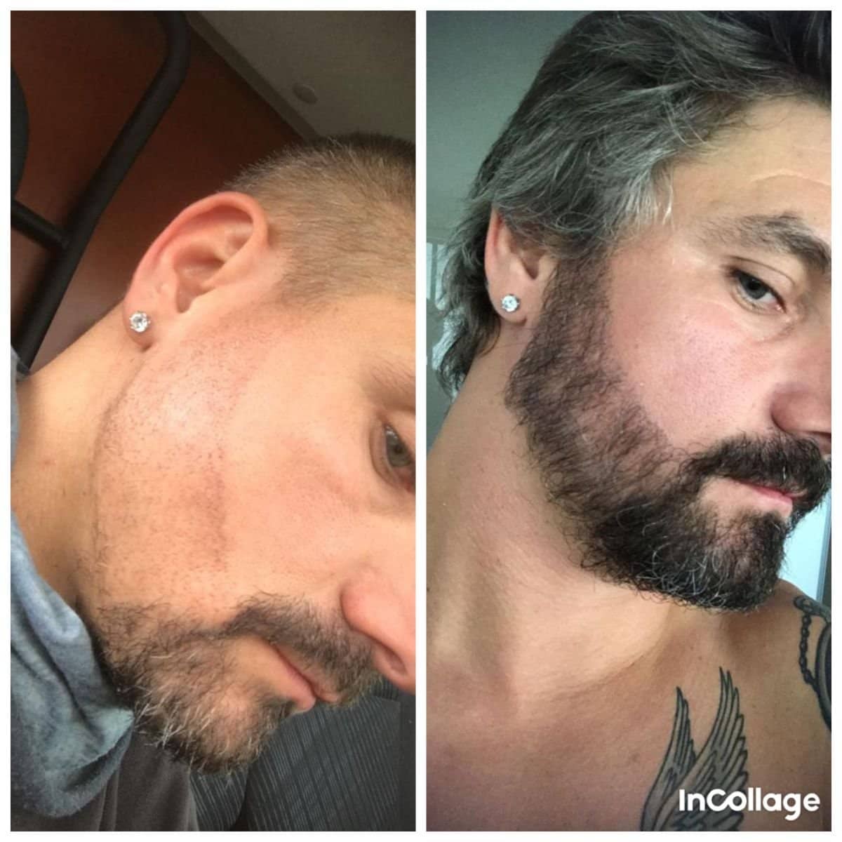 Case 19178 - beard transplant