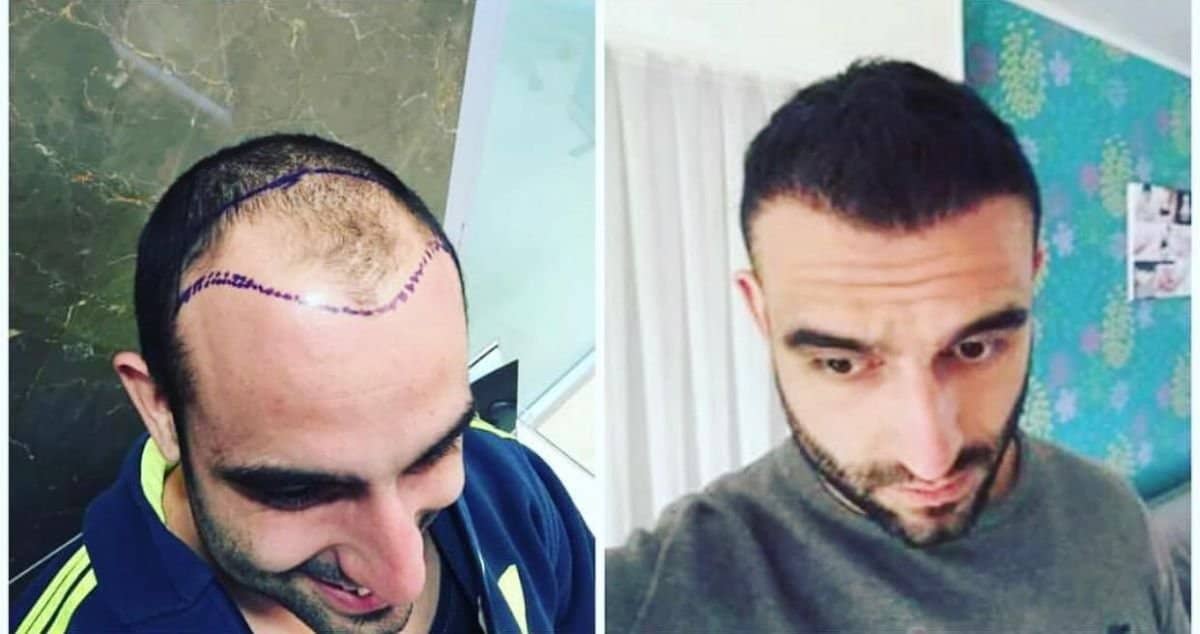 Case 19179 - DHI hair transplant