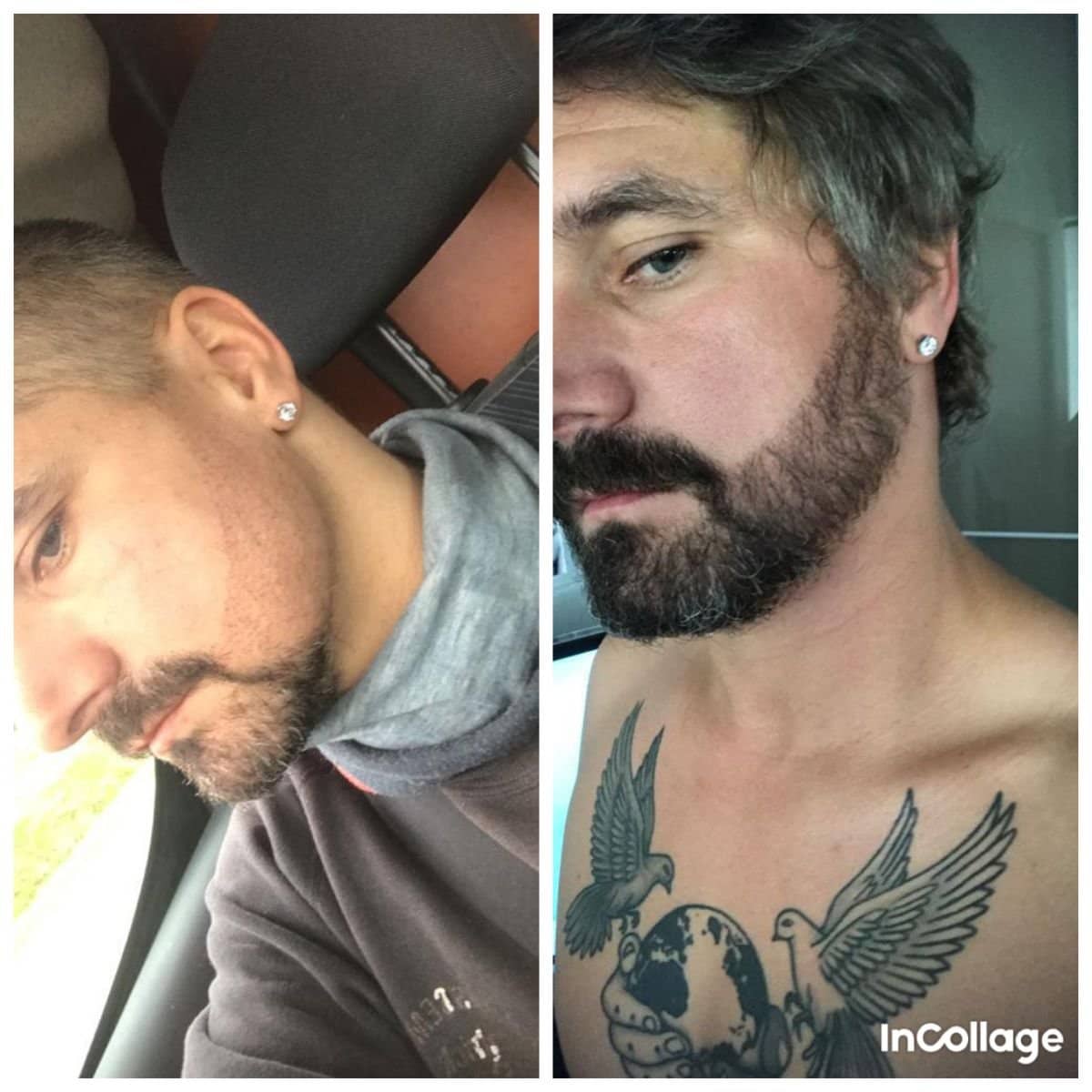 Case 19180 - beard transplant