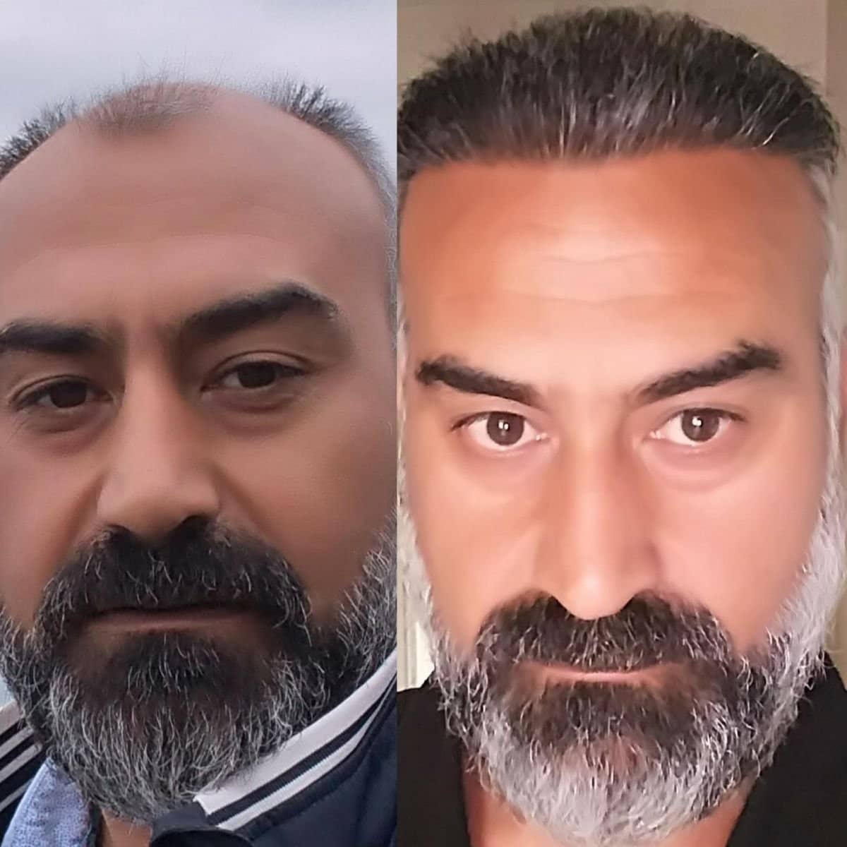 Case 19188 - DHI hair transplant