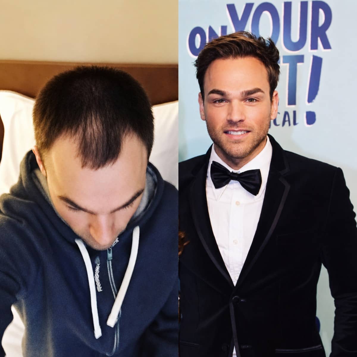 Case 19189 - DHI hair transplant