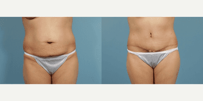 Case 1921 - Woman treated with Tummy Tuck