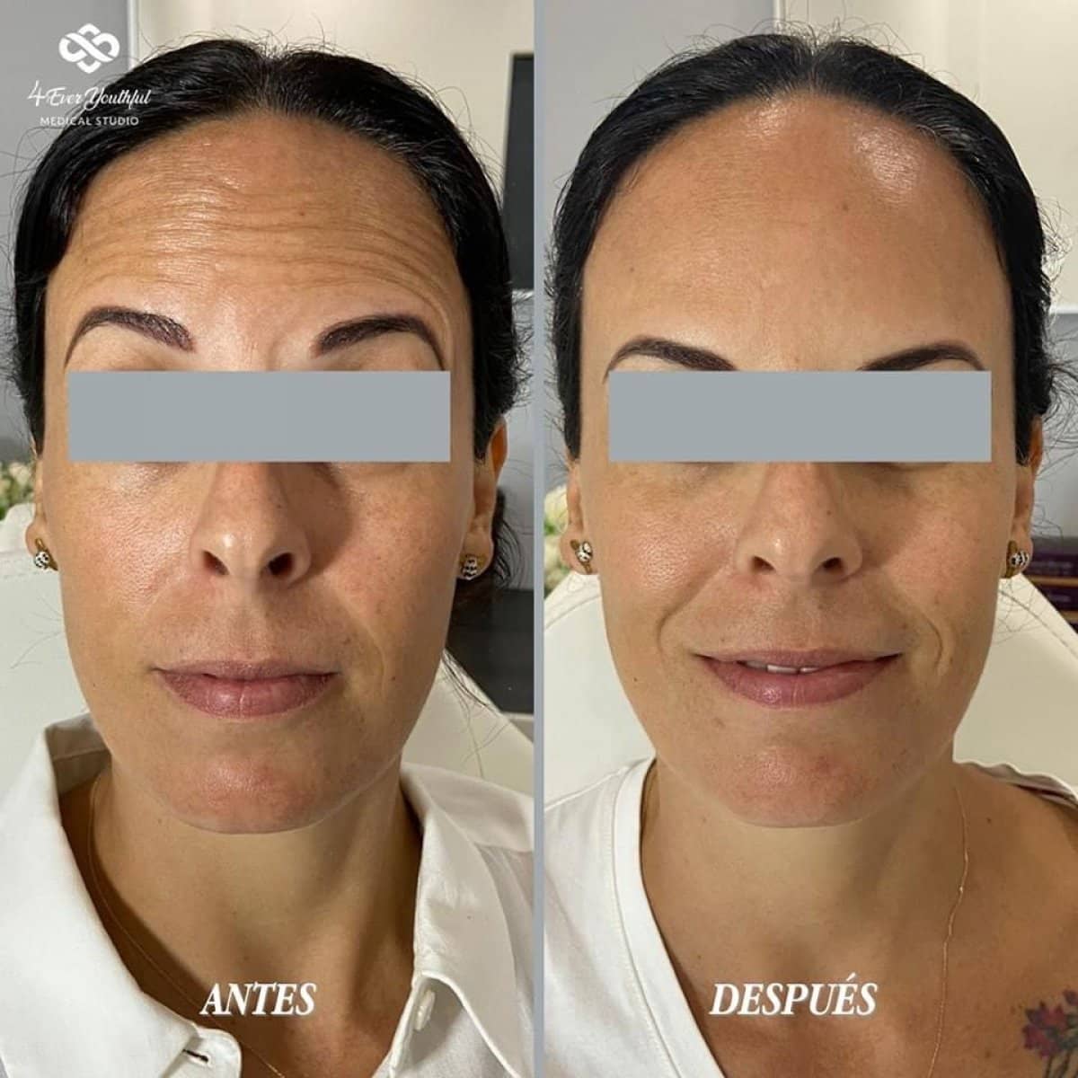 Case 19210 - Botox injections