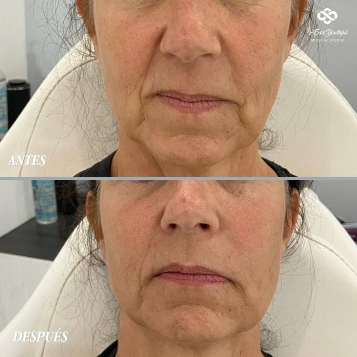 Case 19212 - fillers injection