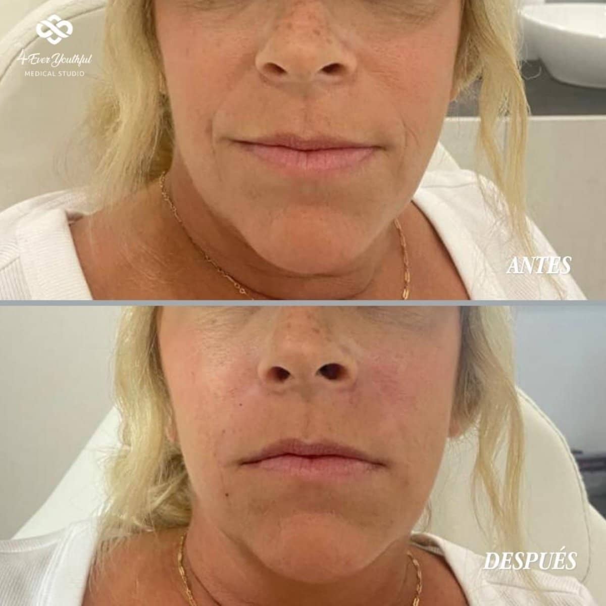 Case 19213 - Botox injections
