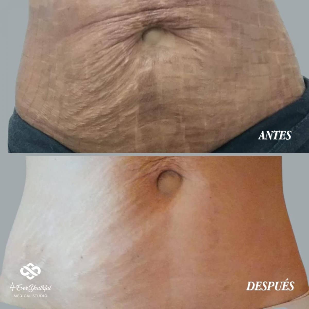 Case 19215 - laser skin resurfacing