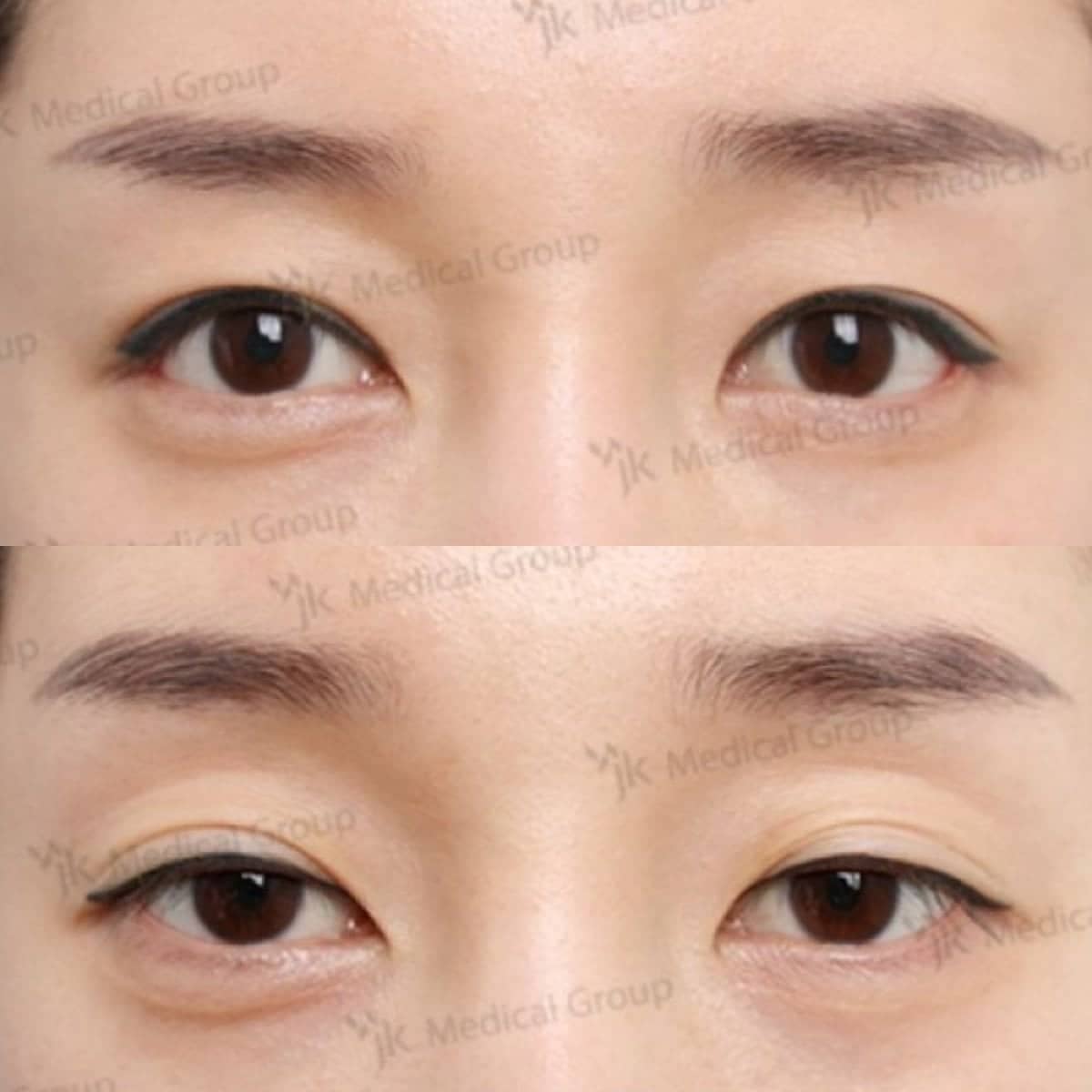 Case 19222 - lazy eyelid surgery