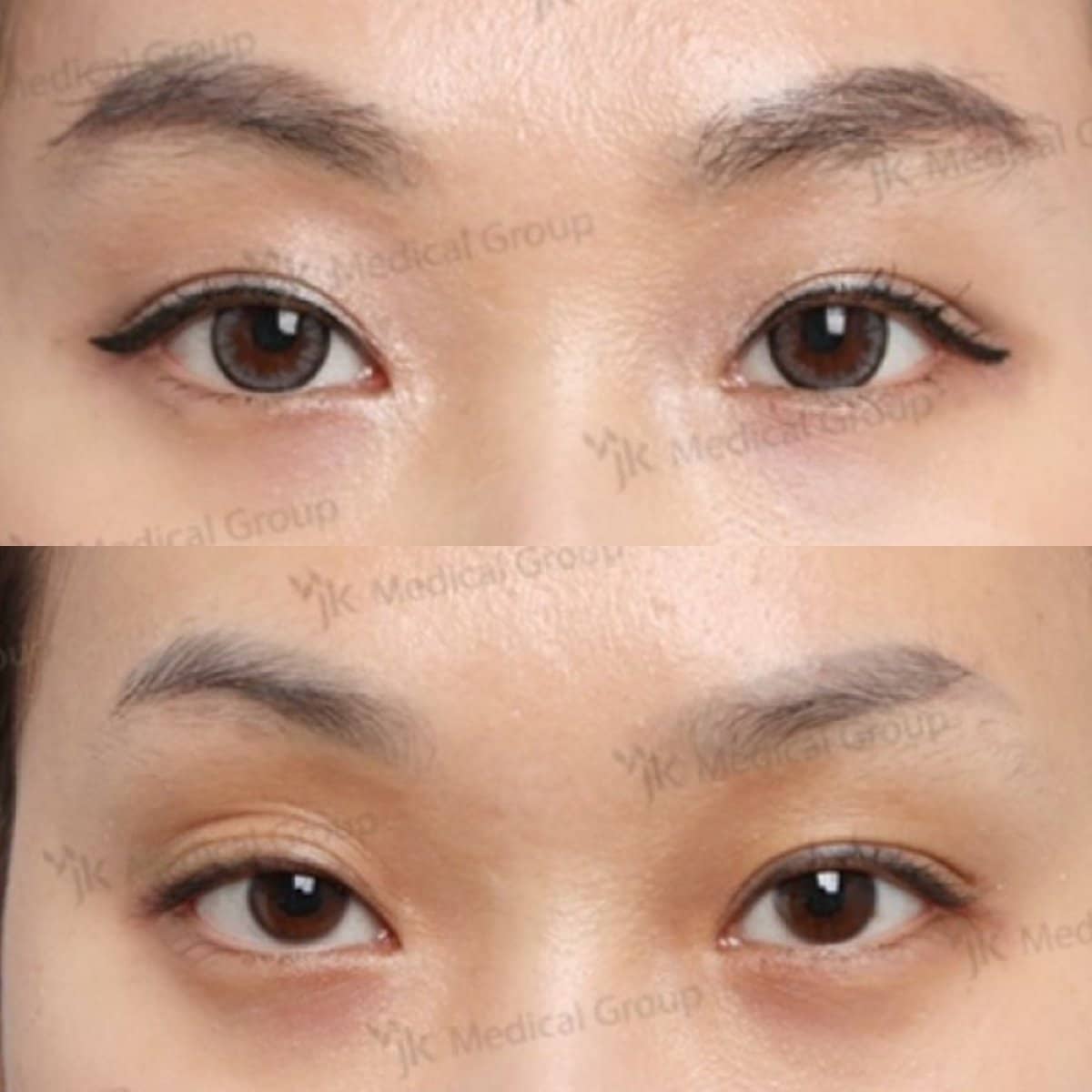 Case 19223 - lazy eyelid surgery