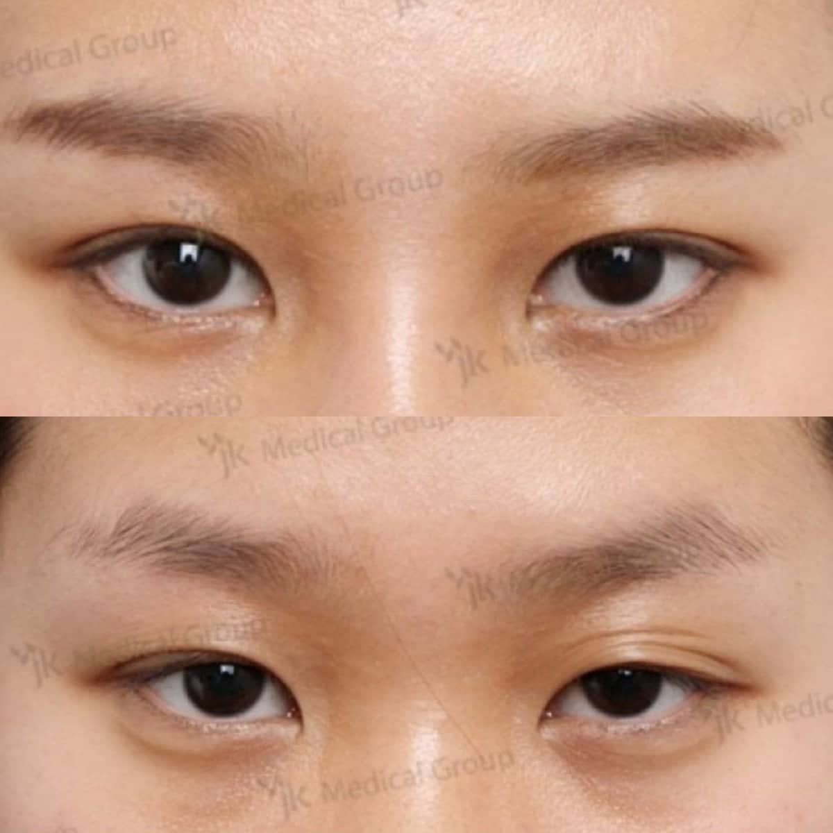 Case 19224 - lazy eyelid surgery