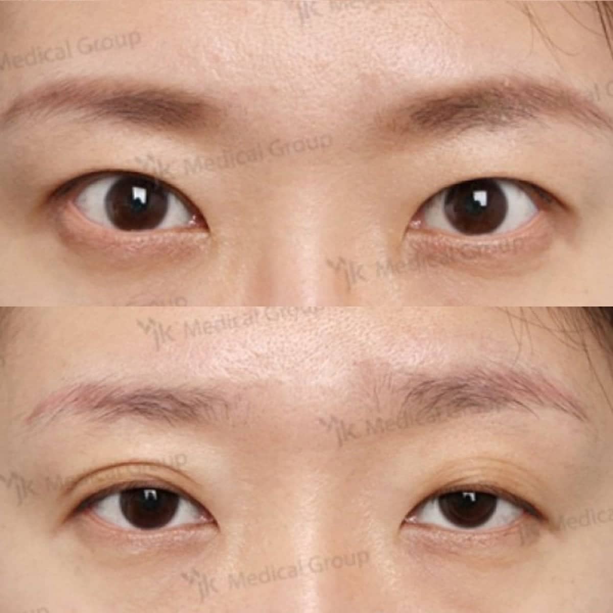 Case 19225 - lazy eyelid surgery