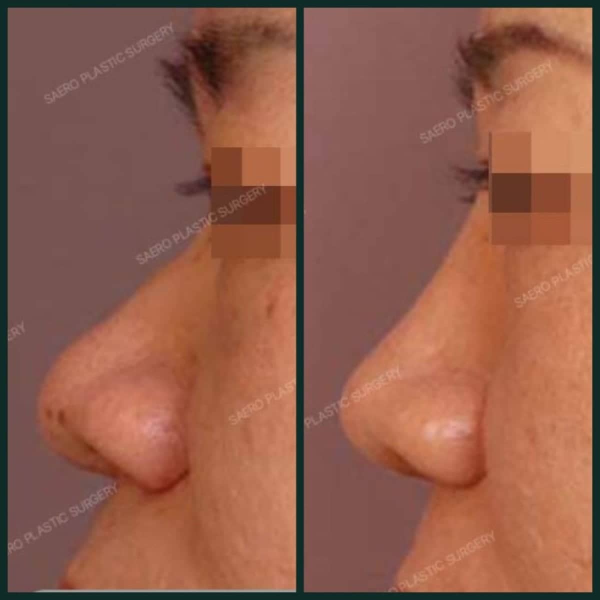 Case 19226 - rhinoplasty