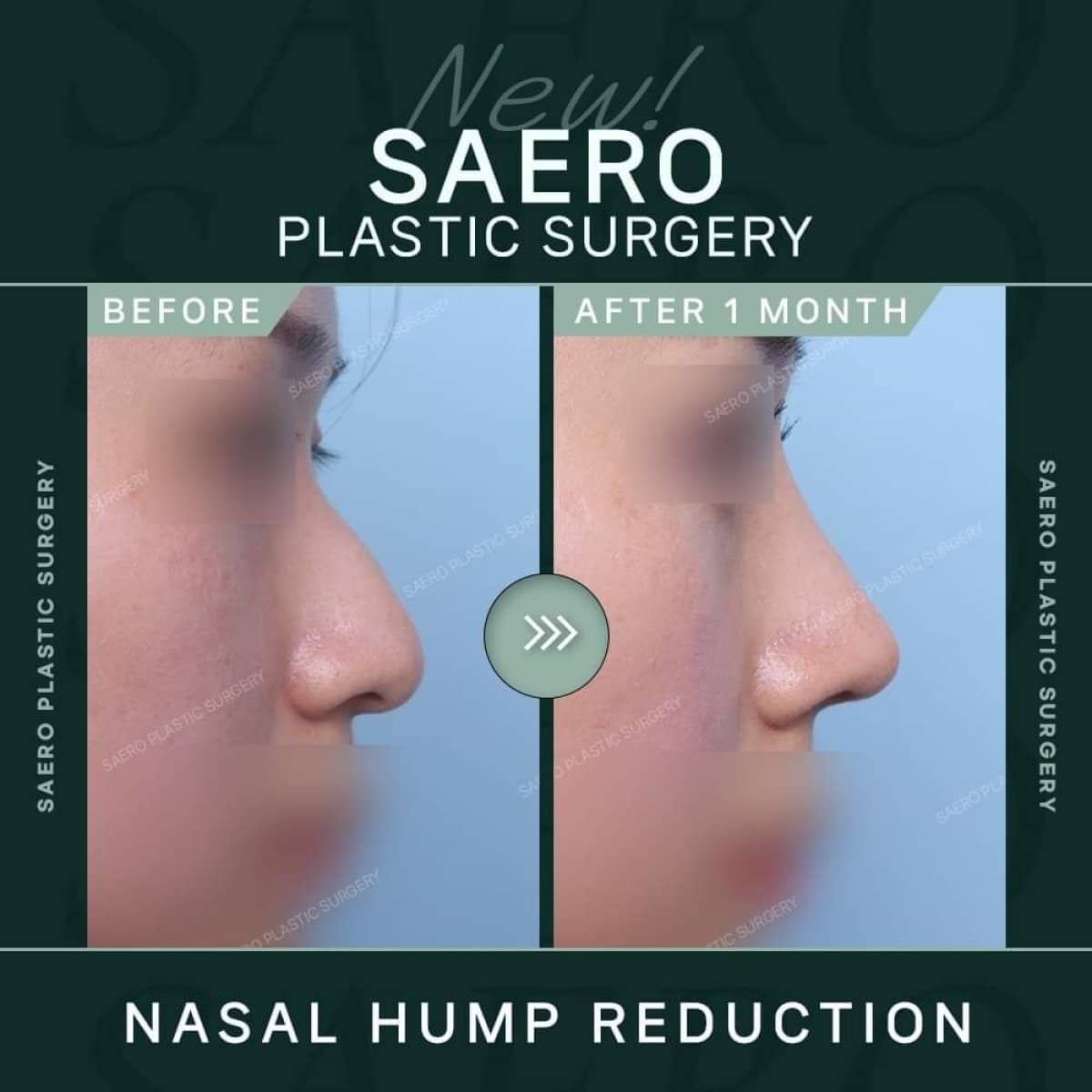 Case 19228 - nasal hump reduction