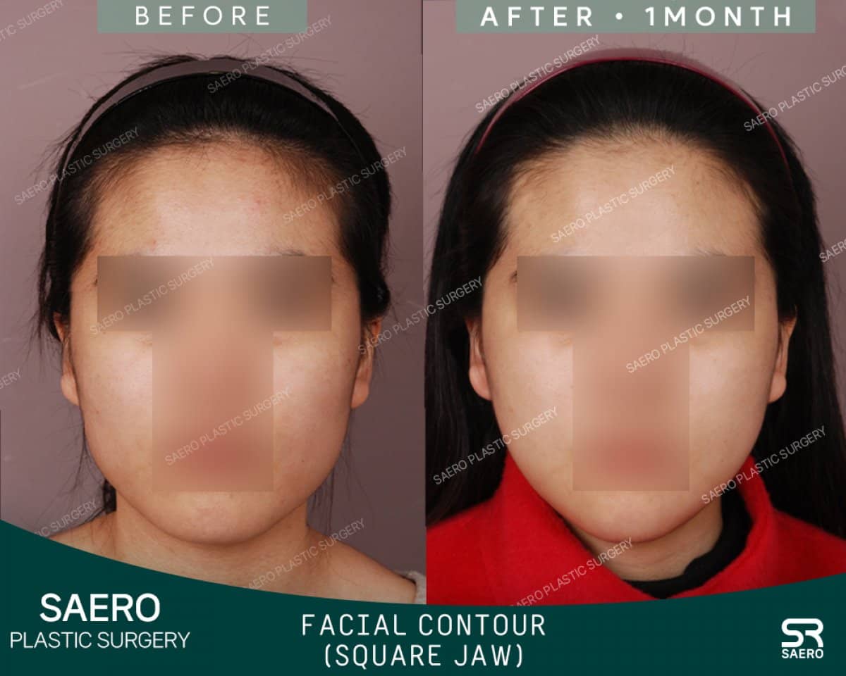 Case 19229 - jaw shaping