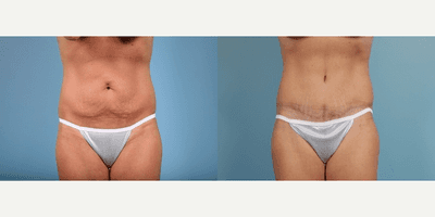 Case 1923 - Woman treated with Tummy Tuck