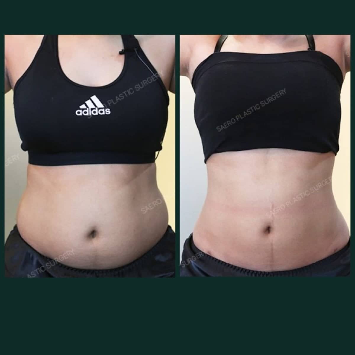 Case 19230 - tummy tuck