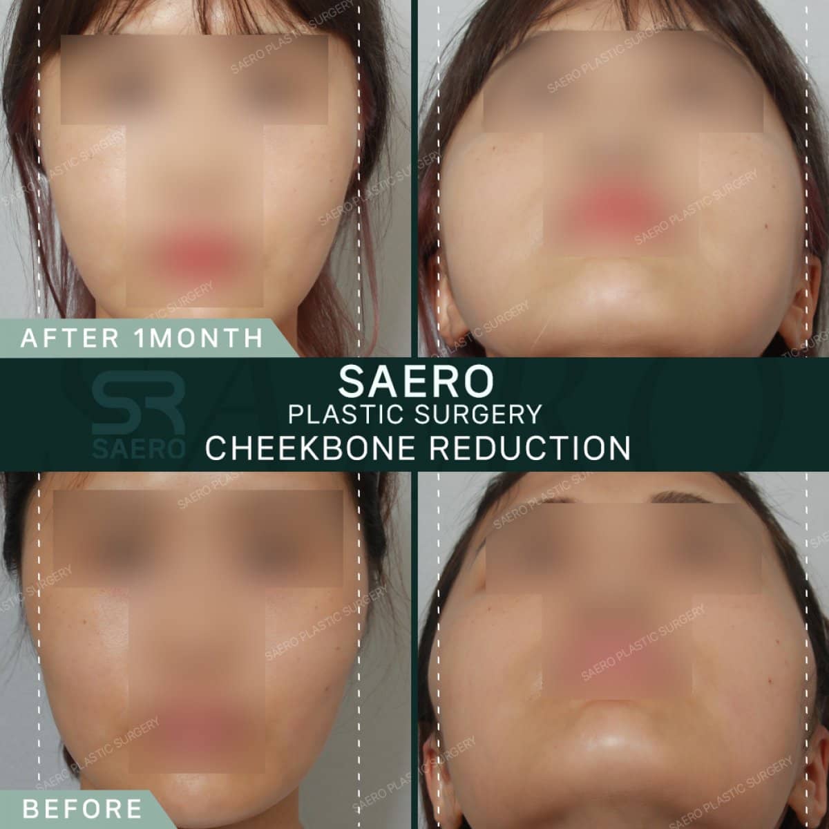 Case 19232 - cheekbone reduction