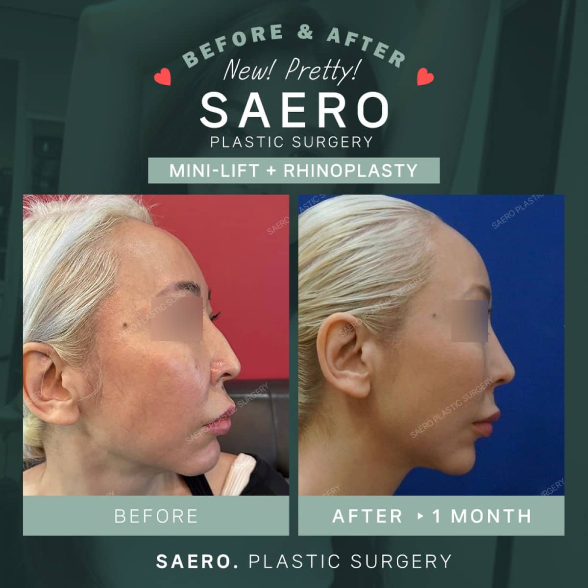 Case 19234 - mini facelift and rhinoplasty