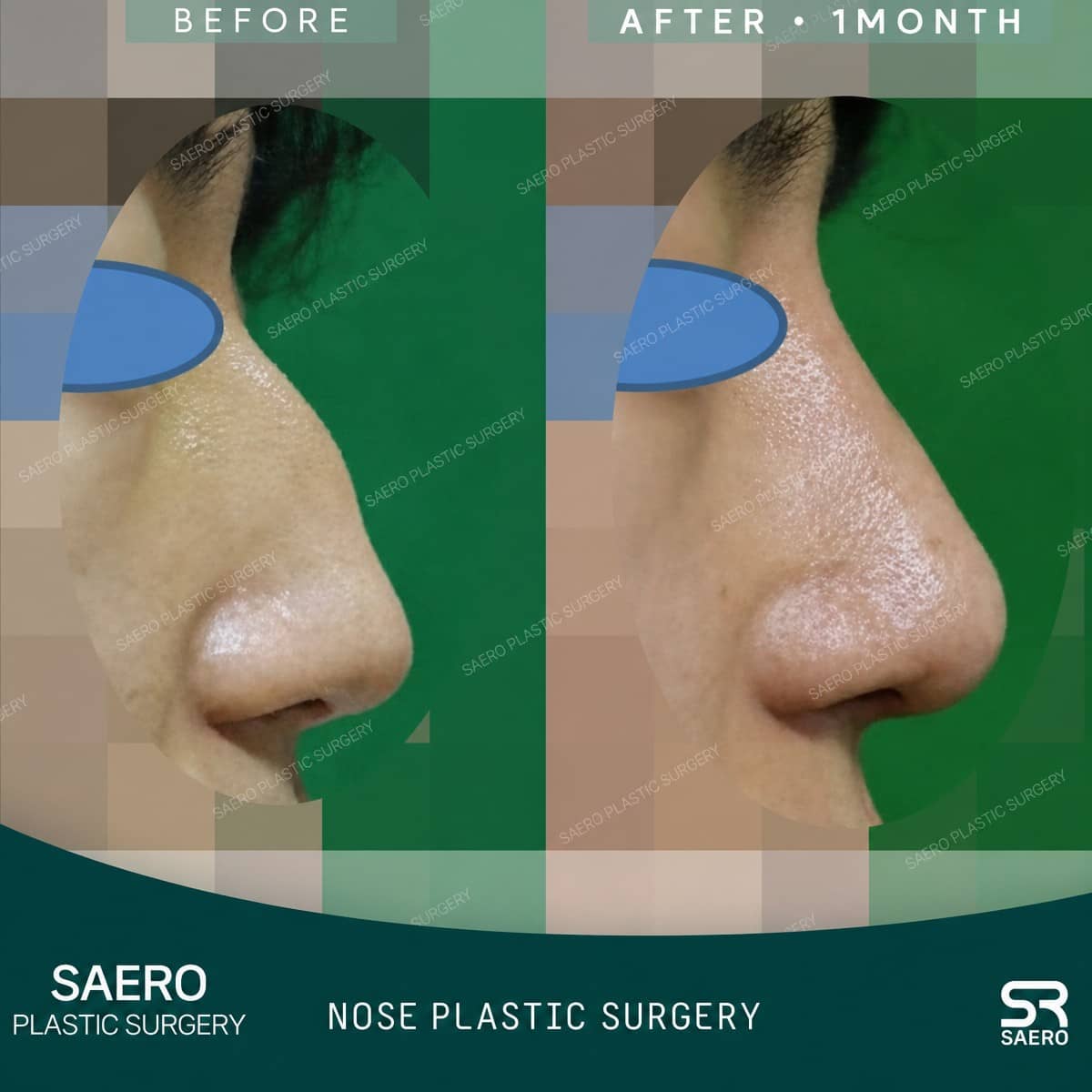 Case 19235 - closed rhinoplasty