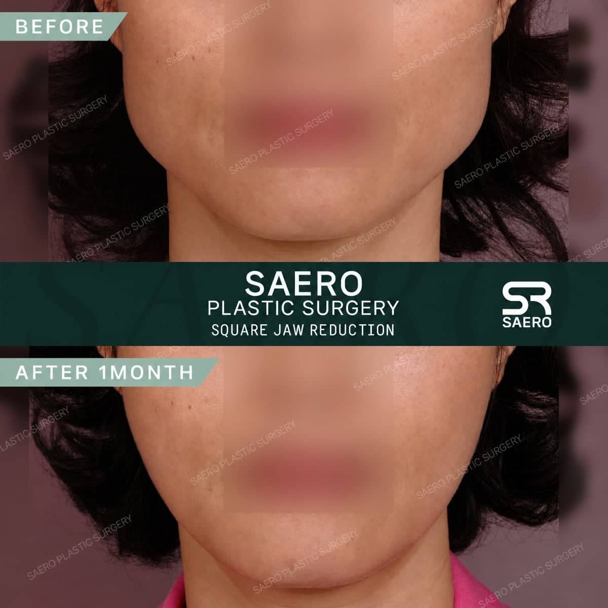 Case 19236 - jaw shaping