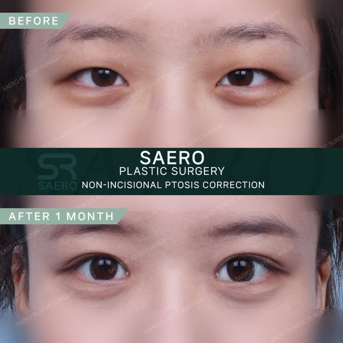 Case 19237 - non-incisional ptosis correction