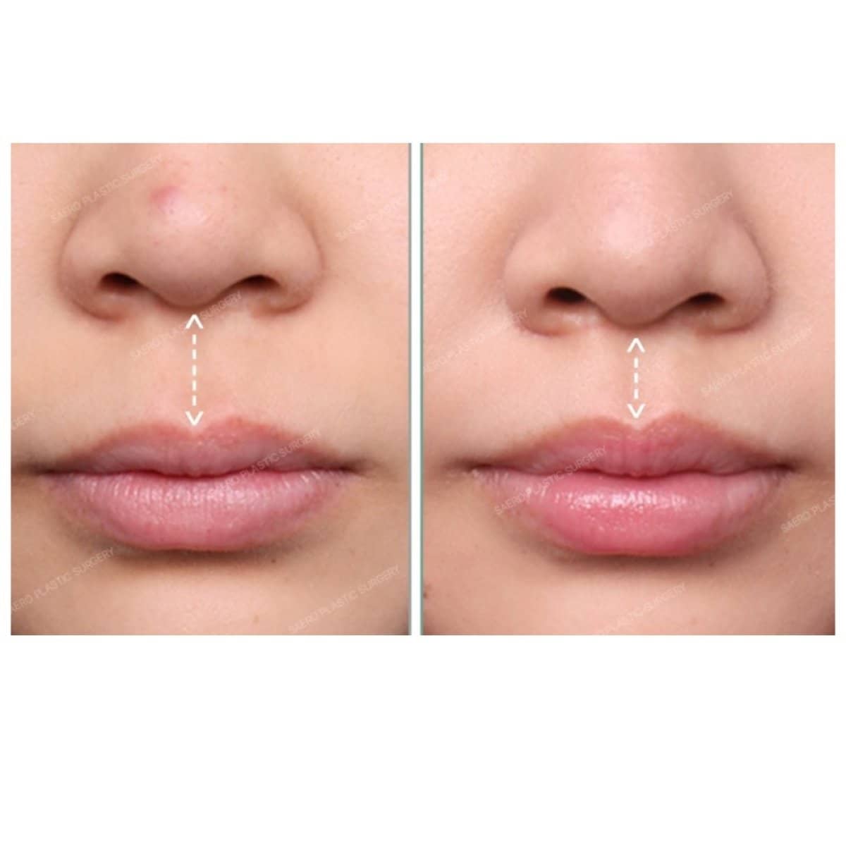 Case 19238 - lip lift