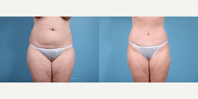 Case 1924 - Woman treated with Tummy Tuck