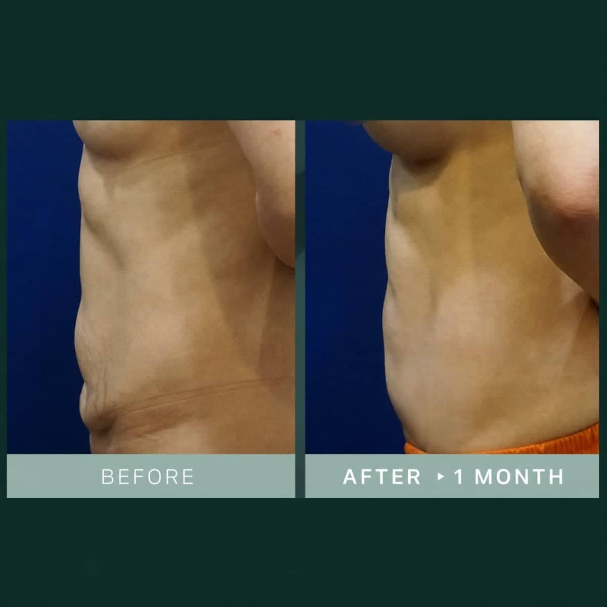 Case 19240 - tummy tuck and liposuction