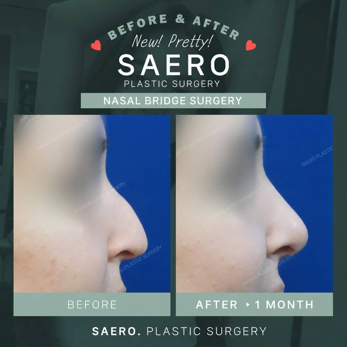 Case 19241 - nasal bridge surgery
