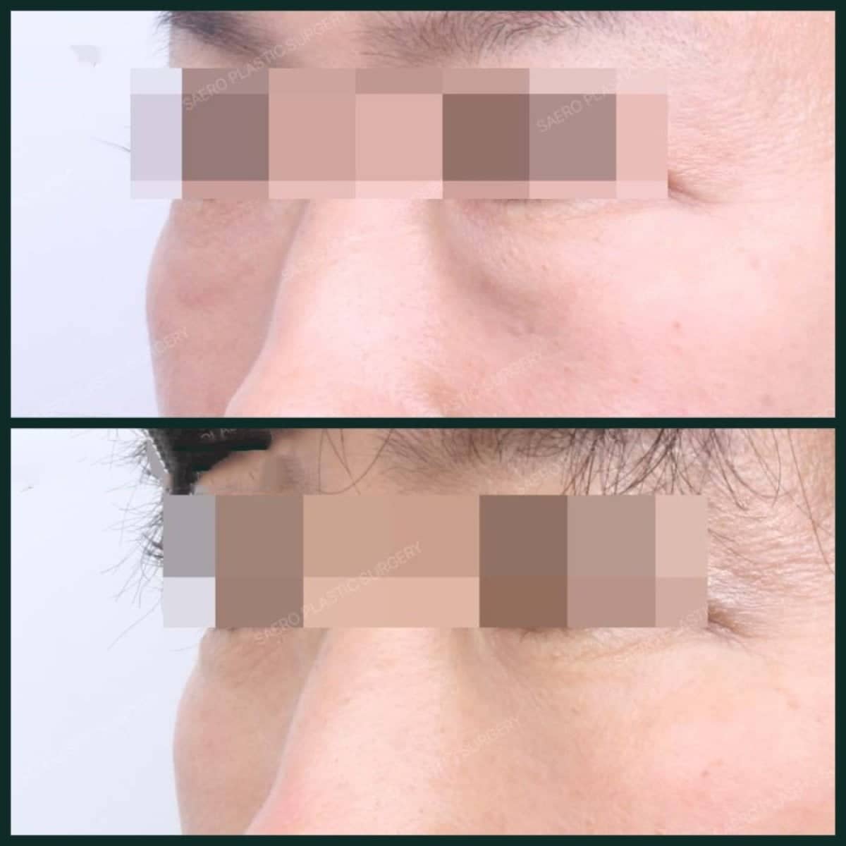 Case 19242 - facial fat transfer