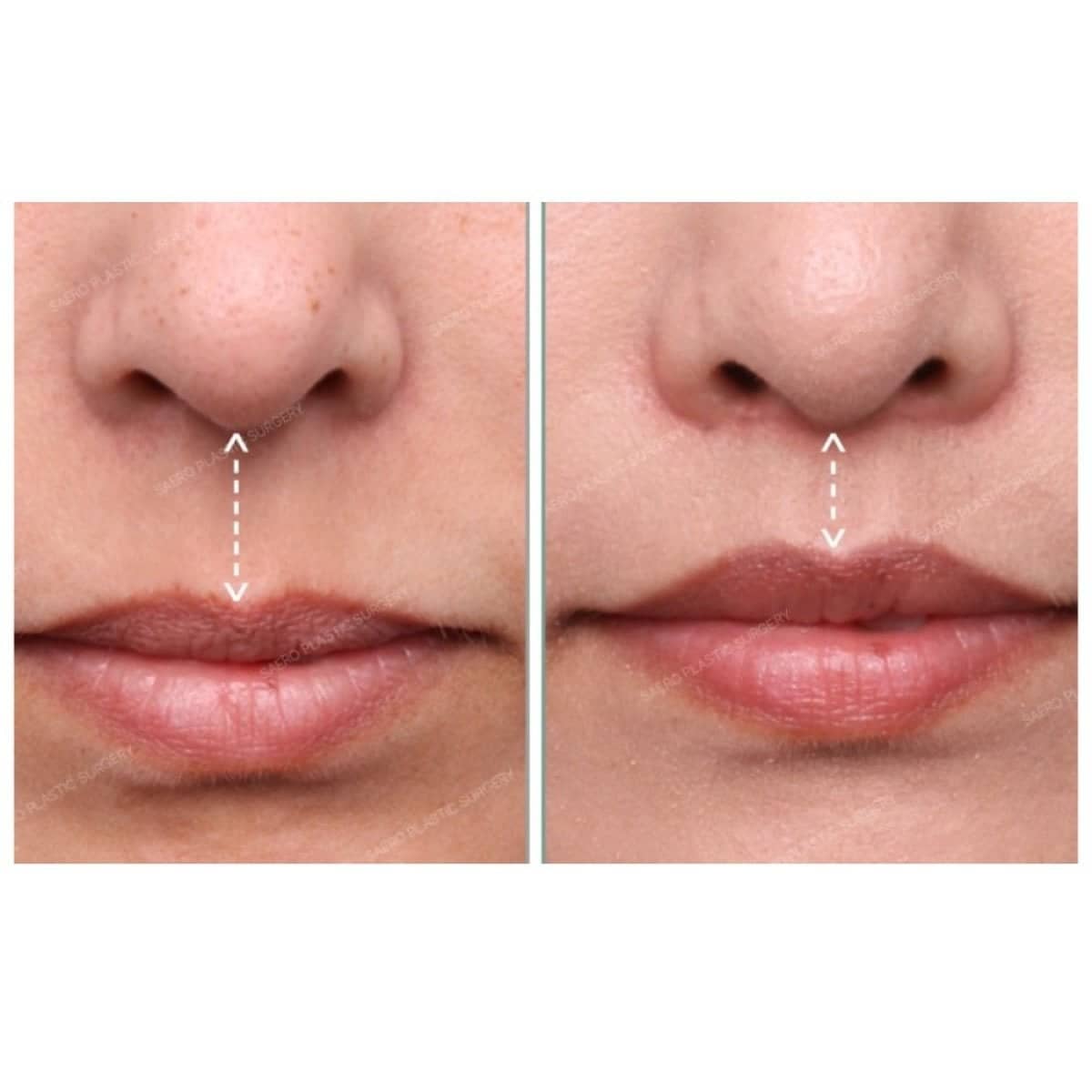 Case 19243 - lip lift