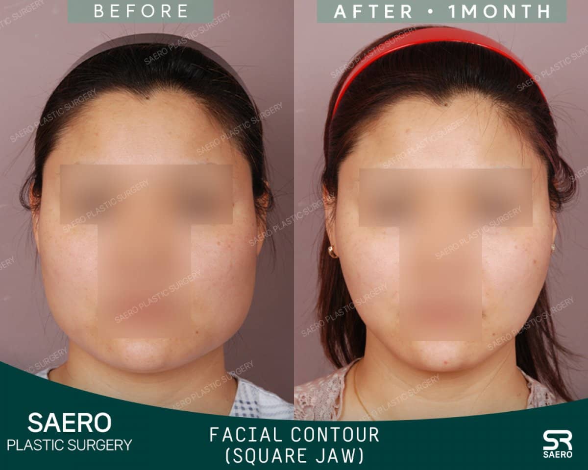 Case 19245 - jaw shaping