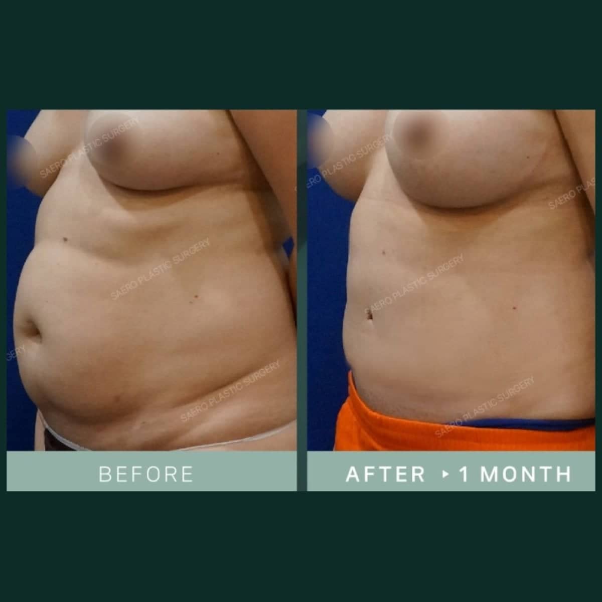 Case 19247 - tummy tuck and liposuction